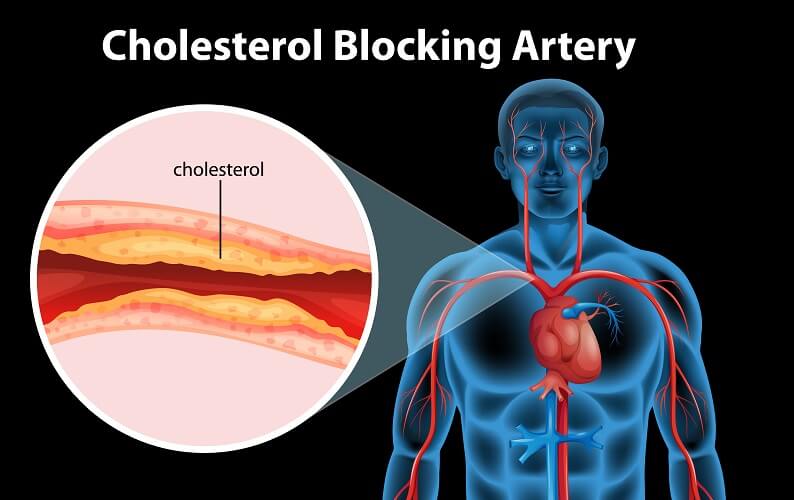 High Cholesterol and Heart Disease Myth or Truth